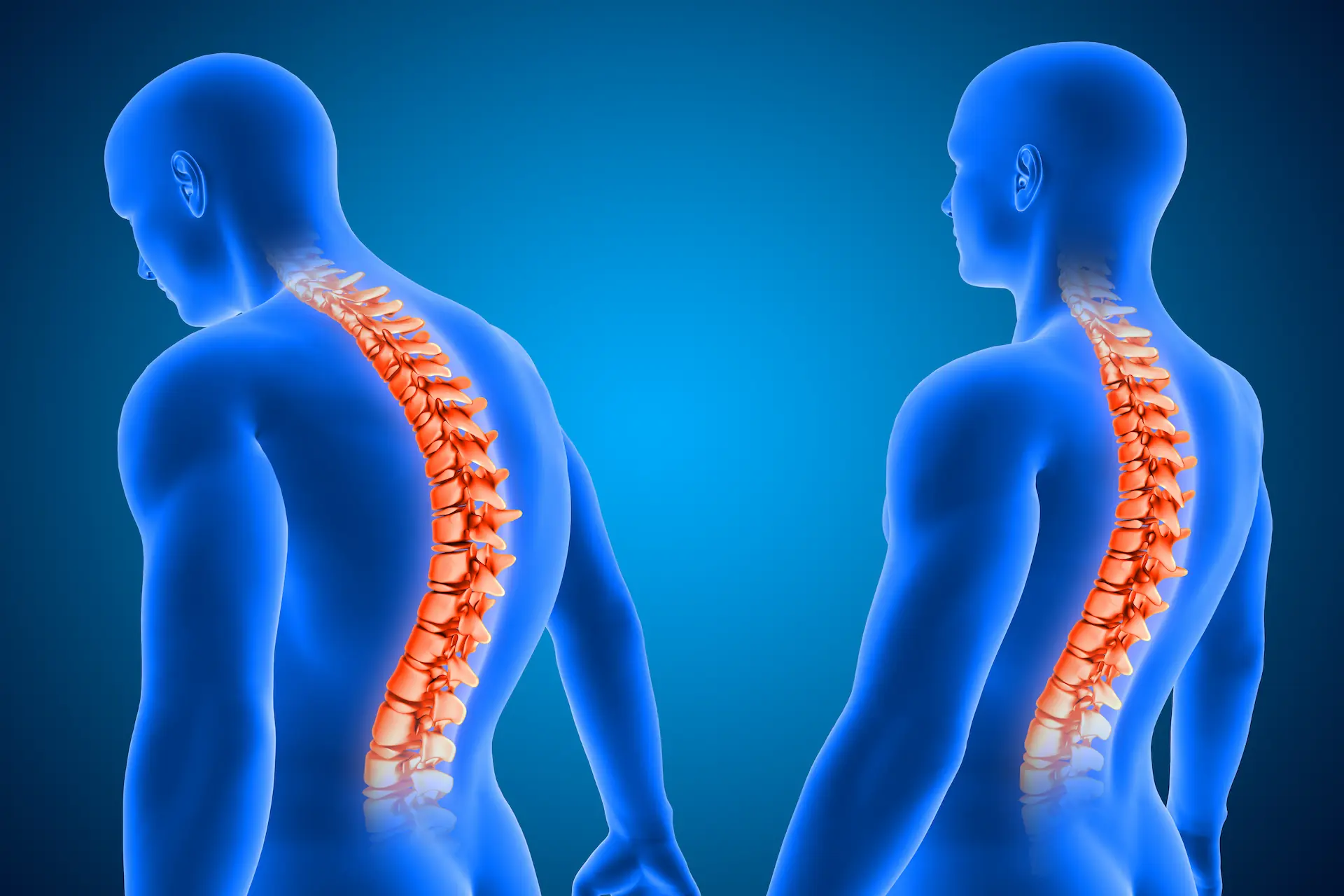 Kyphosis Correction